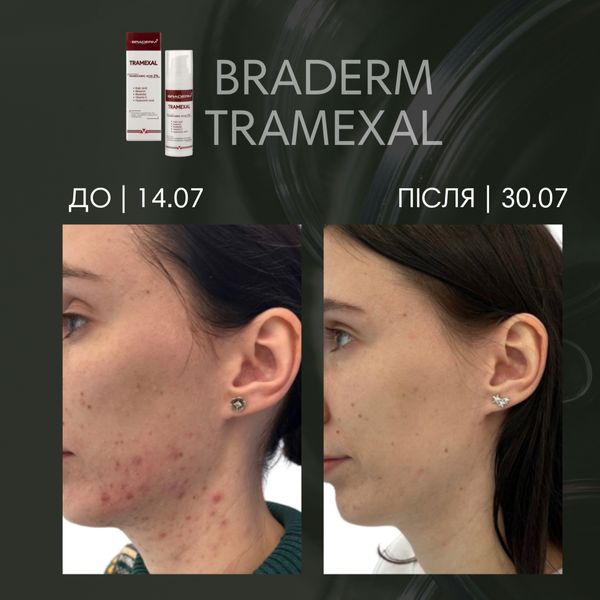 Крем проти пігментації Braderm Tramexal Cream, 30 мл 18820 фото