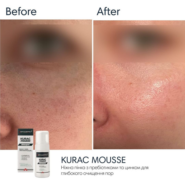 Пінка для вмивання Braderm Kurac Cleansing Mousse, 100 мл 18822 фото